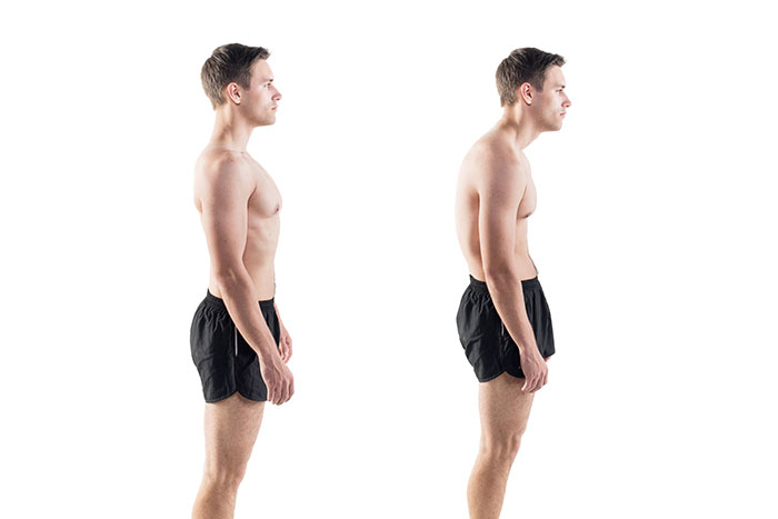 forward head posture example